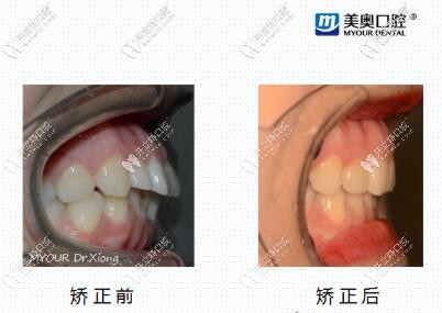 短下巴矯正<span style=