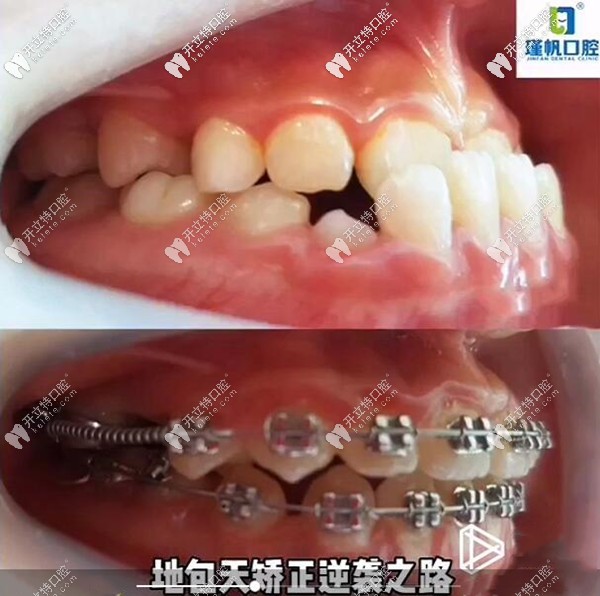 12歲孩子牙齒地包天矯正前后對(duì)比照片