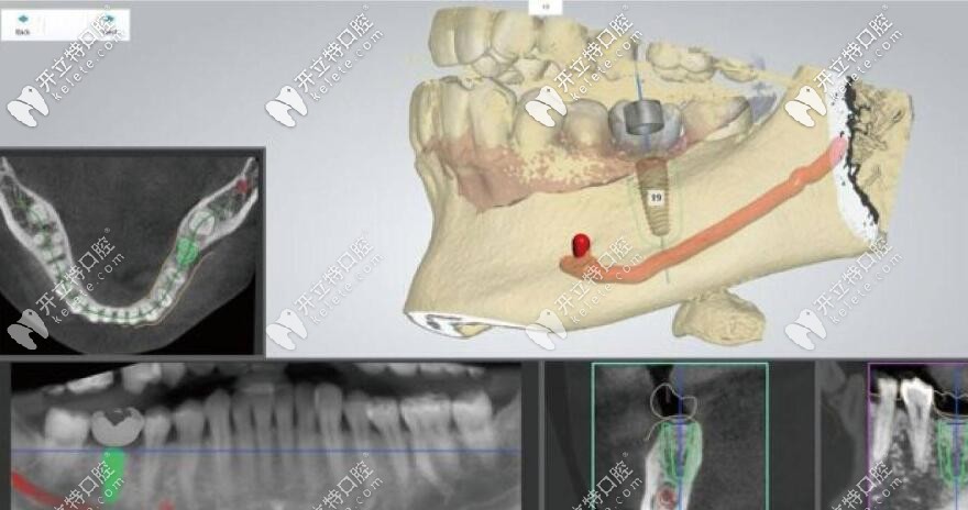 種植牙導(dǎo)板技術(shù)