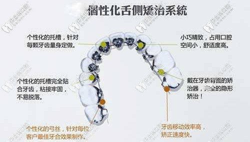 個性化舌側(cè)矯正系統(tǒng)的特點
