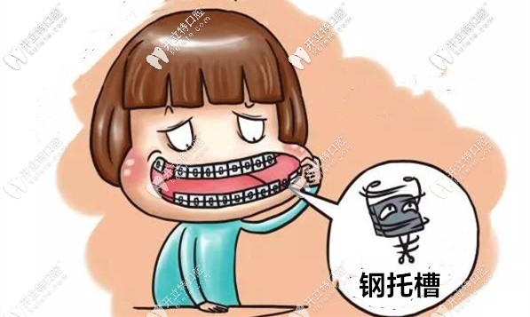 太原市鋼牙套矯正價格表