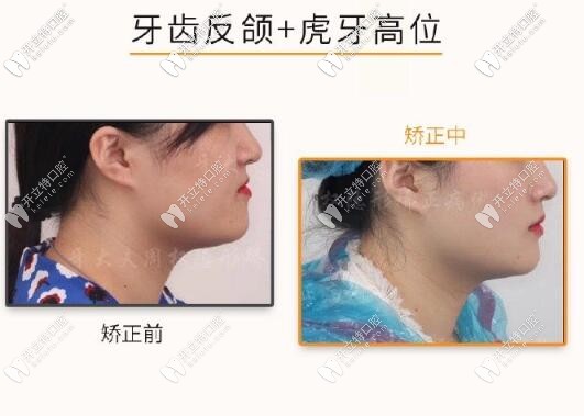 長沙周權(quán)醫(yī)生牙齒矯正案例