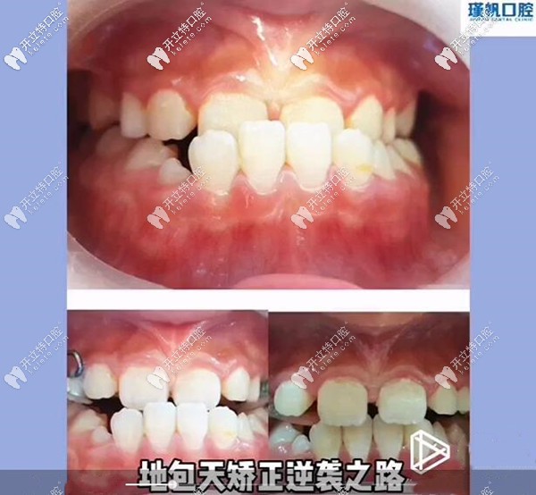 桂林瑾帆口腔兒童地包天牙齒矯正案例