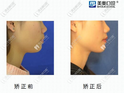 長(zhǎng)沙美奧口腔齙牙矯正<span style=