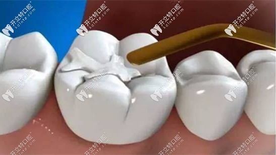 補后槽牙用3M納米樹脂的z350xt還是p60好？