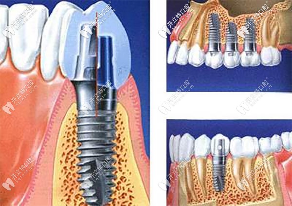 種植牙修復(fù)