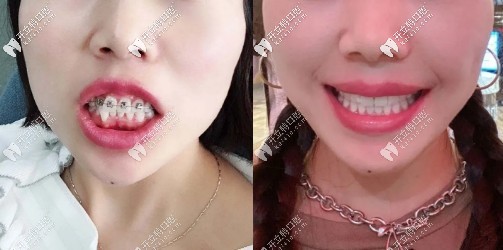 你想看上排牙齒突出用國(guó)產(chǎn)鋼牙套箍牙齒2年后的效果嗎