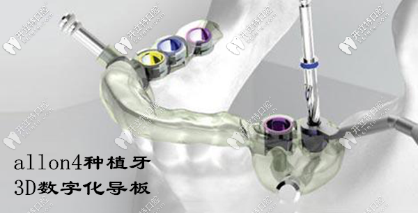 廈門種植全口牙的費用