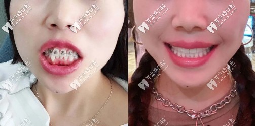 拆除牙套后，喜提一口大白牙