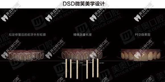 DSD微笑美學(xué)設(shè)計(jì)
