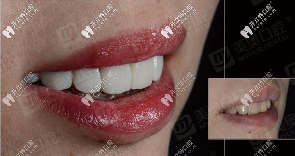 想問：重慶美奧口腔醫(yī)院做義獲嘉全瓷貼面的效果如何？