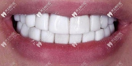 小診所做的牙齒貼面效果差強(qiáng)人意