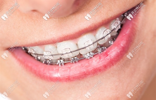 廣州好大夫口腔的正畸費(fèi)用介紹
