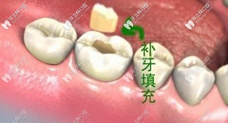 3M納米樹脂補(bǔ)牙各型號(hào)的區(qū)別及用途