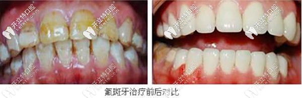 氟斑牙做emax全瓷牙貼面