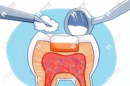 牙齒齲壞要及時修復(fù) 牙齒齲壞要及時修復(fù)