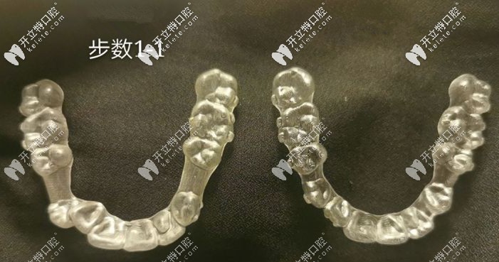 剛拿到的牙套和兩年后的牙套對比