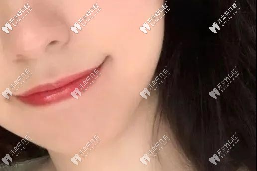 雖說還沒結(jié)束，但嘴巴已經(jīng)變好看了哦