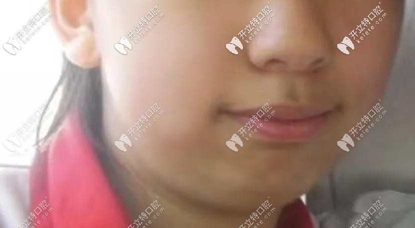 門牙突出導(dǎo)致口呼吸，下巴后縮的問題