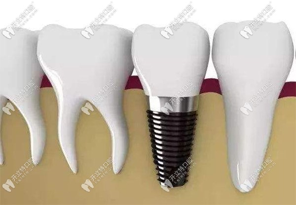 德國瑞西歐種植體優(yōu)勢