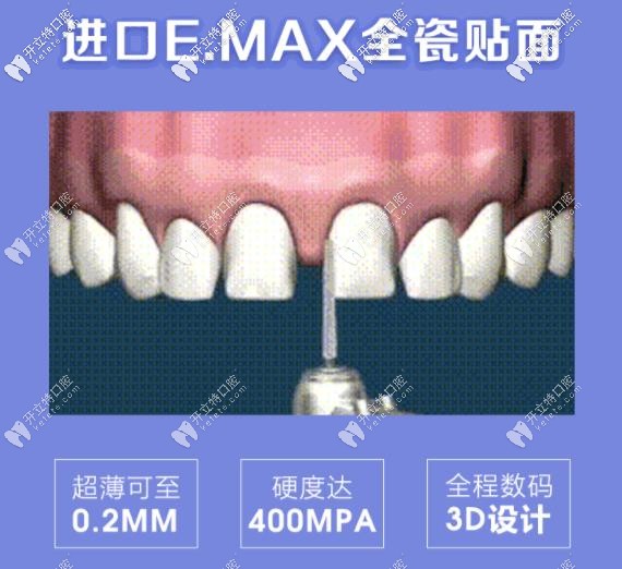 牙齒修復黑科技：emax貼面是鑄瓷還是玻璃陶瓷你了解嗎