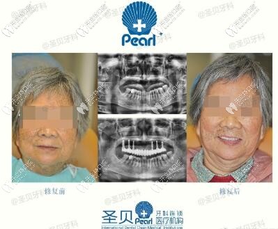 西安圣貝口腔半口種植牙案例
