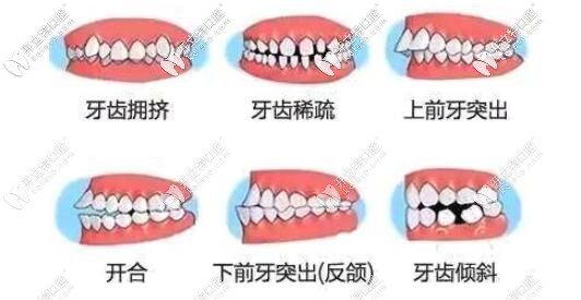 各種牙列不齊的危害