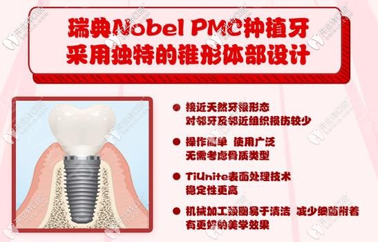諾貝爾pmc種植體優(yōu)勢