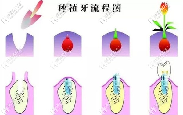 成都武侯區(qū)君臣口腔種植牙費用堪比鑲牙