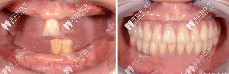 全口種植牙<span style=