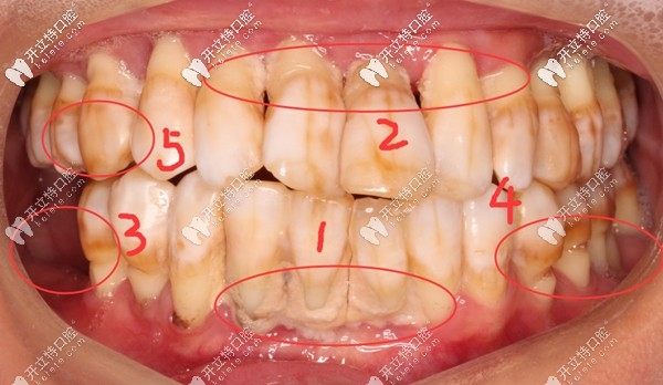 顧客種牙前的口內(nèi)照