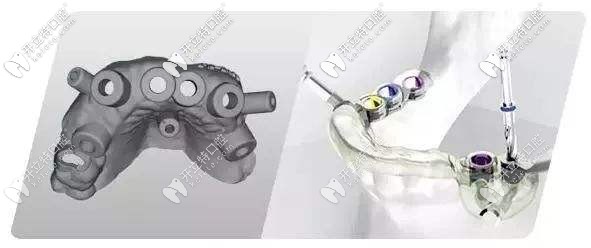 通過CAD/CAM激光掃描和CBCT實(shí)現(xiàn)導(dǎo)板種植