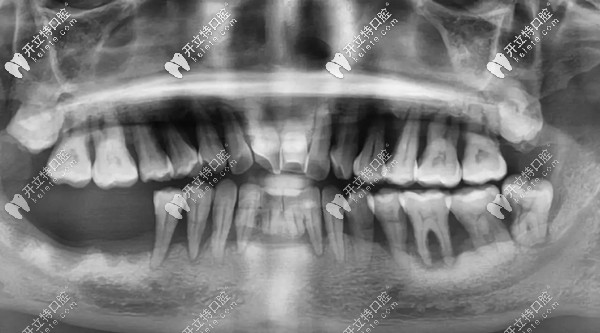 顧客做全口種植牙前的全景片圖