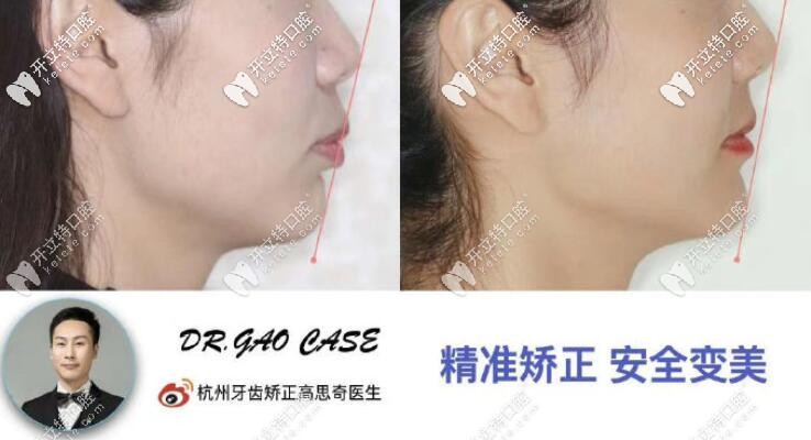 剛整理的杭州美奧口腔凸嘴齙牙矯正案例及收費(fèi)價(jià)格