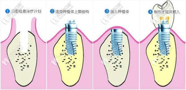 即刻種植牙的流程