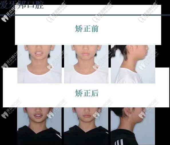 反頜牙齒擁擠,14歲兒童的拔牙之國(guó)產(chǎn)金屬自鎖托槽矯正之旅