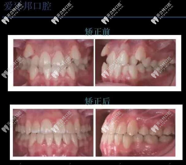 反頜矯正 婁底愛牙邦口腔醫(yī)院