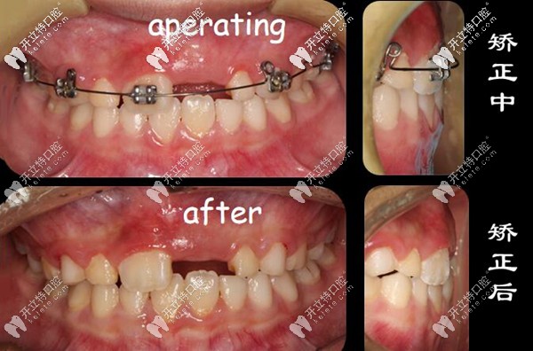 染指弘瑞口腔兒童地包天矯正案例 染指弘瑞口腔兒童地包天矯正案例