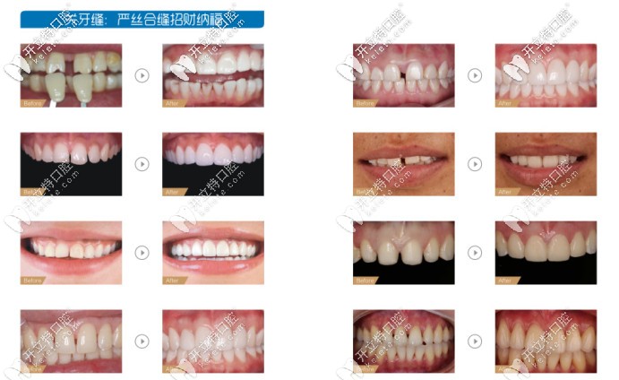 美學(xué)修復(fù)前后對比圖