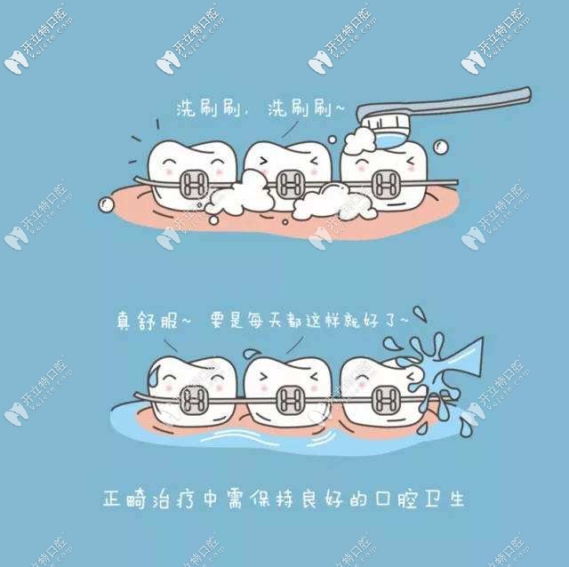 正畸期間注意牙齒衛(wèi)生