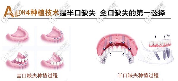 北京市朝陽區(qū)維樂做allon4速導半口種植牙價格是多少？