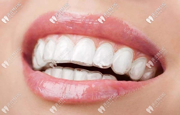 活動(dòng)期間訂購(gòu)正雅隱形矯正可免方案和取模費(fèi)