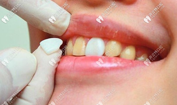 <!--<i data=20240703-sp></i>-->的牙齒貼面也有特價(jià)