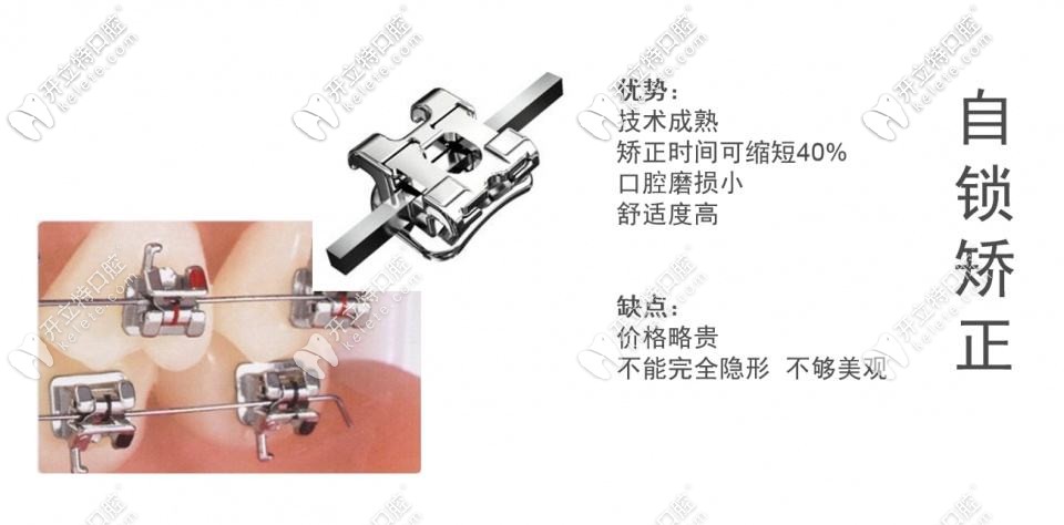 銀川做牙齒矯正大概需要多少錢?去哪家做正畸要好一點
