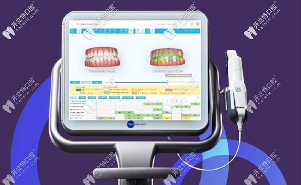 在南充美昂口腔做隱形牙齒矯正,可體驗(yàn)iTero口掃預(yù)覽效果哦