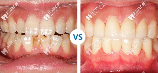 貴陽(yáng)華美口腔修復(fù)案例