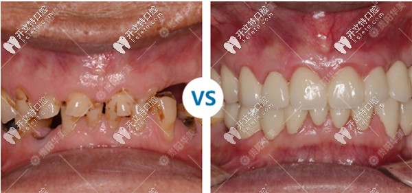 貴陽(yáng)華美口腔種植牙案例