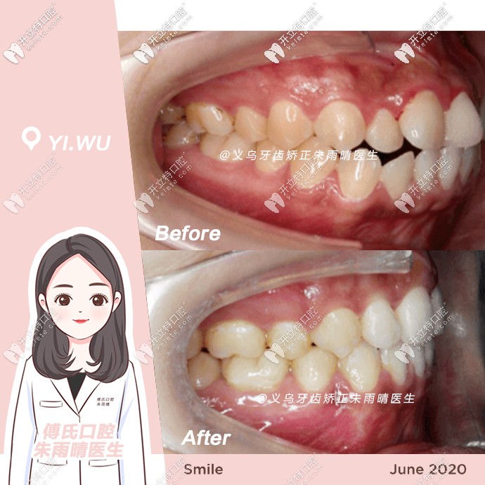 傅氏口腔矯正案例前后對比