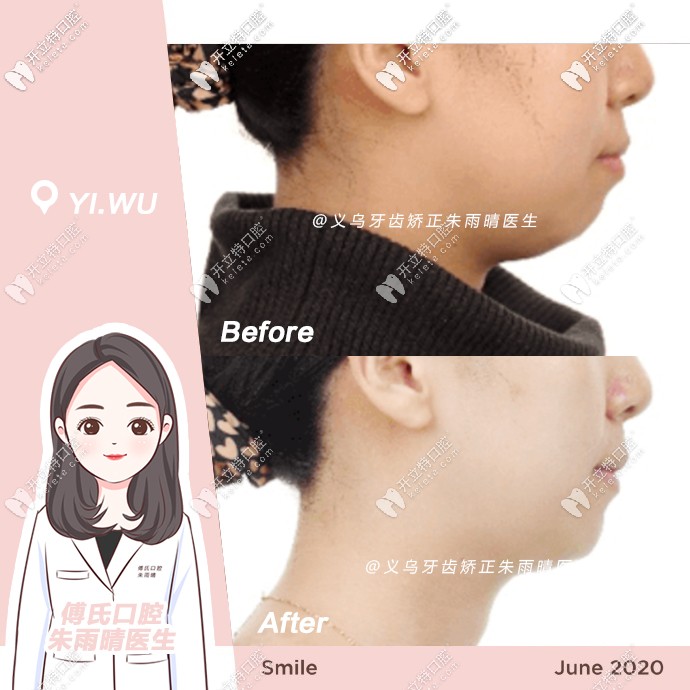 骨性二類矯正前后對比側面照