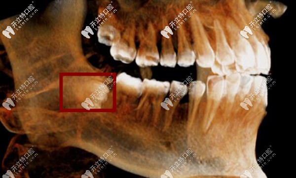 復(fù)雜埋伏智齒